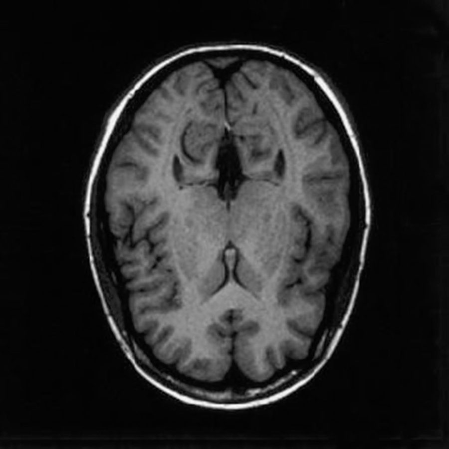 Brain Injuries Plague the Masses